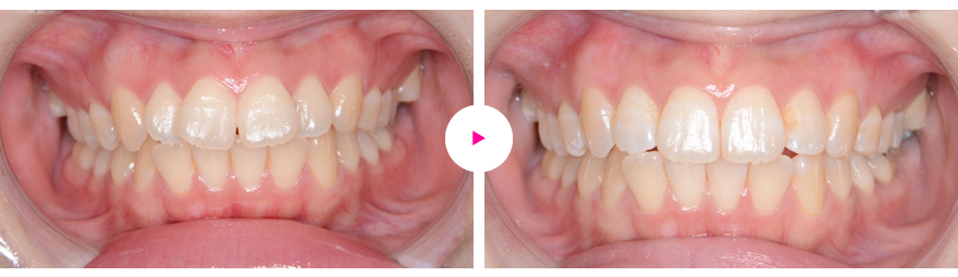 上下前歯の叢生や前方突出などの治療例（治療期間6ヶ月）