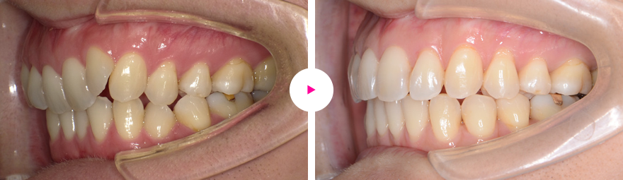 重症度の高い非抜歯の治療例（重度の前歯の凸凹（叢生）と奥歯の咬み合わせのズレ）