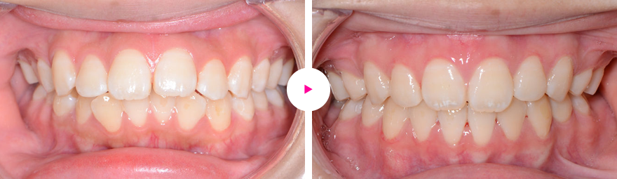 中〜重度の歯槽性の上下顎前突、口唇閉鎖不全の治療例