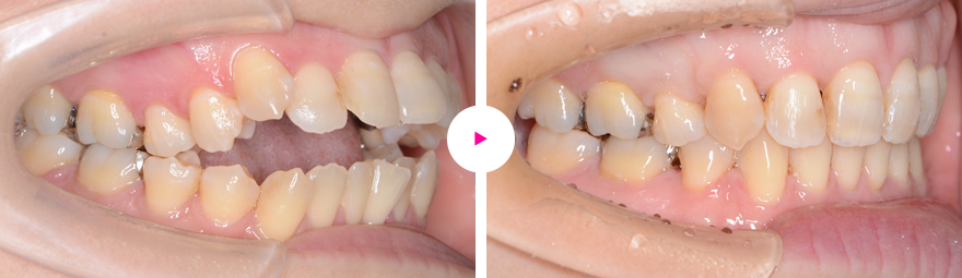重度の開咬と前歯の突出（出っ歯）の矯正治療例