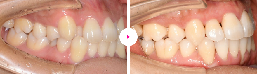 重度の叢生（八重歯、狭窄歯列、反対咬合）の治療例