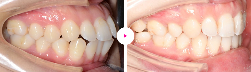 非常に重度な口ゴボ（著しい歯槽性の上下顎前突）の治療例