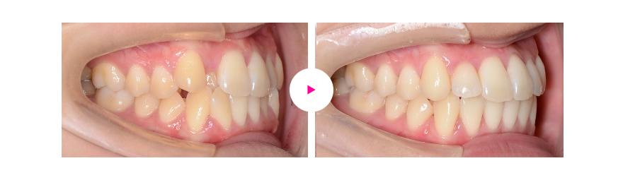 歯の凸凹（叢生）と八重歯の非抜歯での矯正治療例