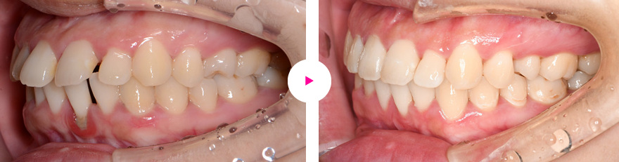 重度の歯肉退縮を伴う「すきっ歯」（空隙歯列）の治療例