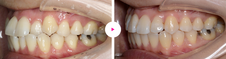 重度の口ゴボ（歯槽性の上下顎前突と口唇閉鎖不全）の矯正治療例